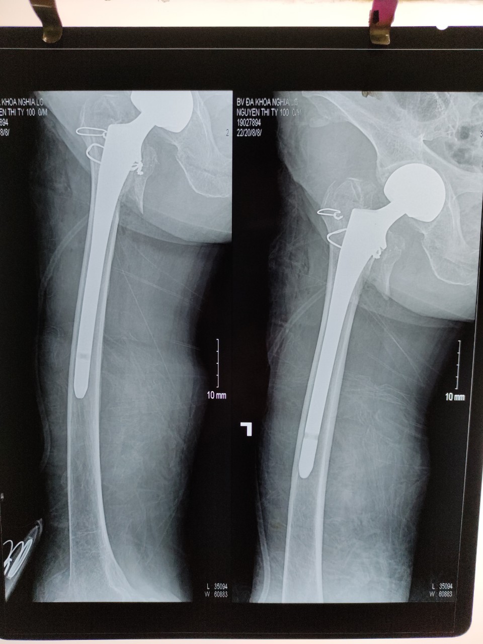 Hình ảnh tin tức PHẪU THUẬT THAY KHỚP HÁNG CHO BỆNH NHÂN 100 TUỔI