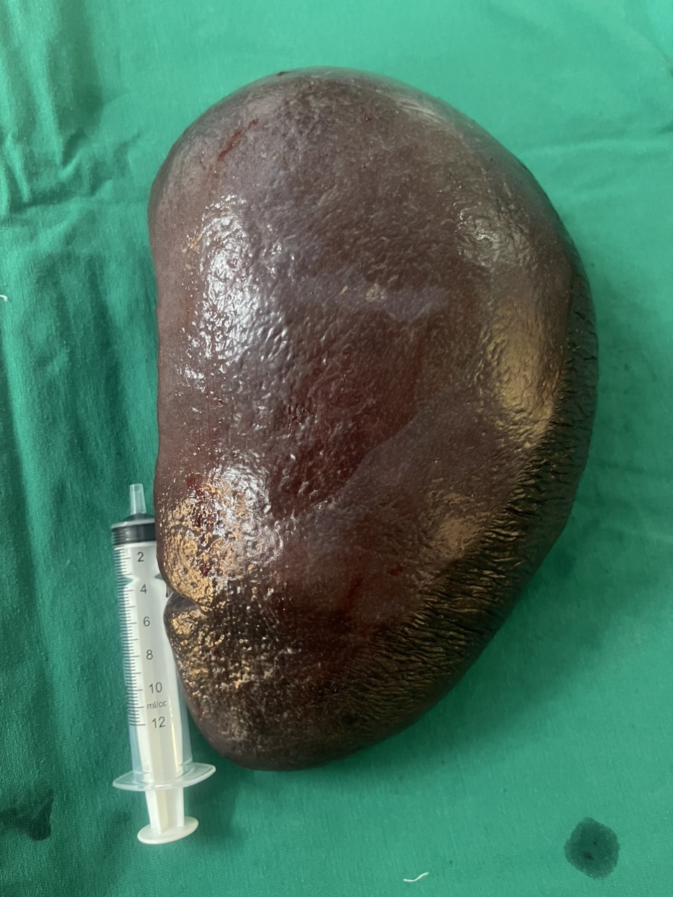 Hình ảnh tin tức Phẫu thuật cách Lách "khủng" 2kg cho bệnh nhi 12 tuổi mắc bệnh thiếu máu huyết tán