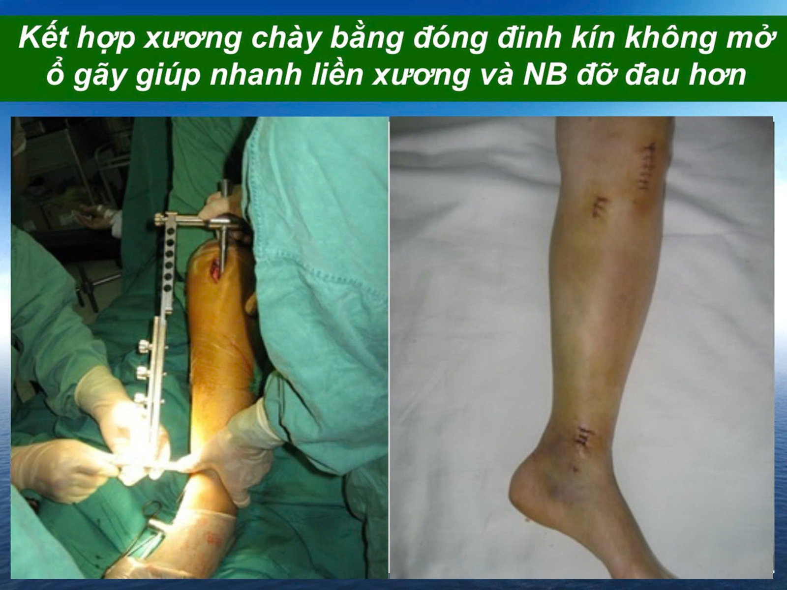 Hình ảnh tin tức PHẪU THUẬT KẾT HỢP XƯƠNG: PHỤC HỒI NHANH – VẬN ĐỘNG SỚM