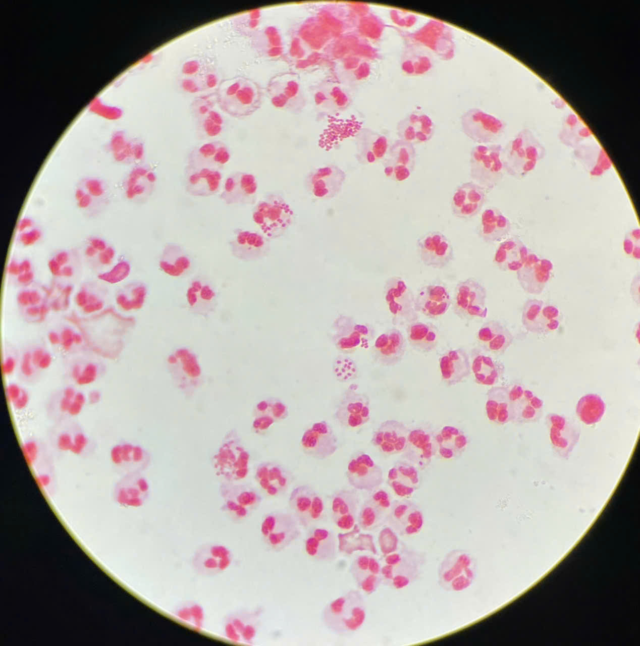 Hình ảnh tin tức PHÁT HIỆN CA BỆNH LẬU – HẬU QUẢ TỪ “CHUYỆN ẤY” KHÔNG AN TOÀN!