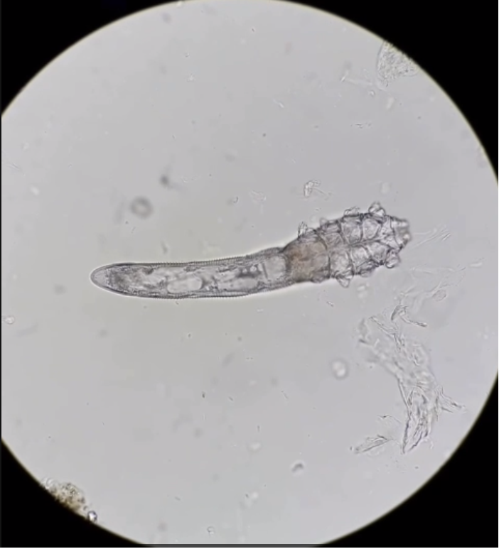 Hình ảnh tin tức 🧬 CẢNH BÁO: DEMODEX – “KẺ TÍ HON” GÂY RẮC RỐI TRÊN DA MẶT! 